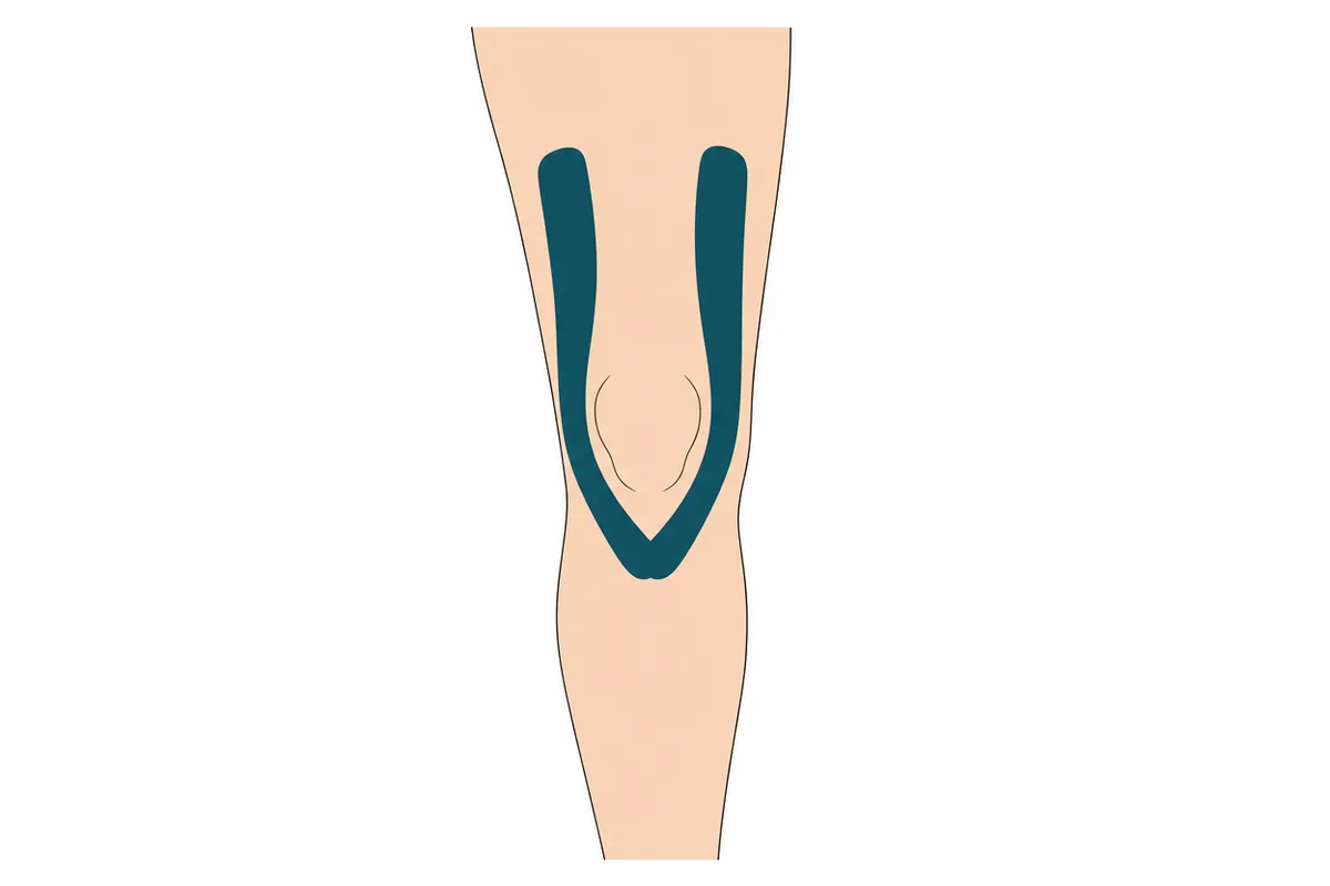 Line drawing of the knee with kinesiology tape placement shown as teal strips